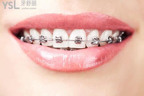 天津美奧口腔自鎖托槽牙齒矯正好不好