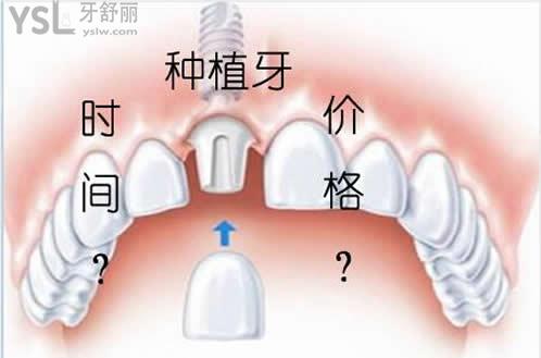 天津美奧口腔種植牙價(jià)格
