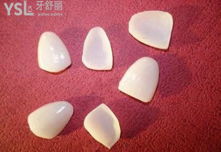 醫(yī)生建議做烤瓷牙貼面要謹慎？