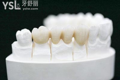 固定假牙和活動(dòng)假牙哪個(gè)好？