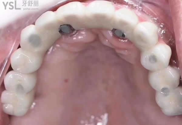 22歲換掉一口牙齒需要多少錢？