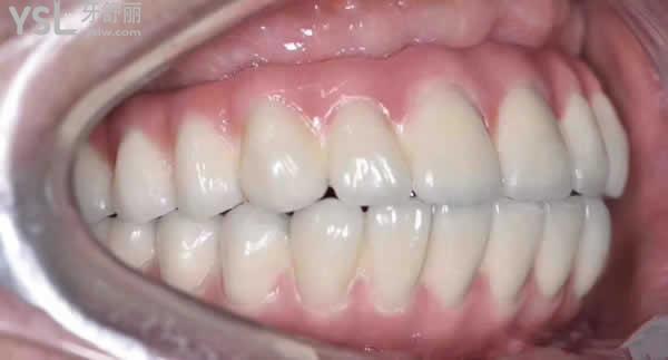 22歲換掉一口牙齒需要多少錢？