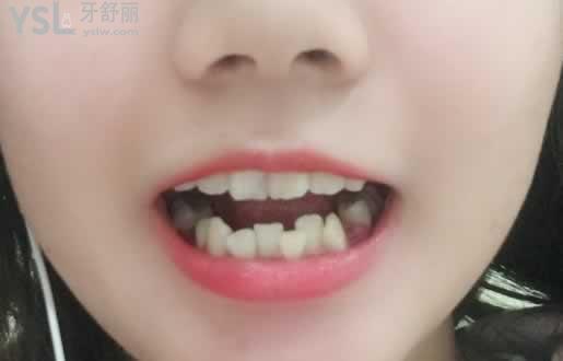二十歲矯正牙齒后悔，只要去正規(guī)的口腔醫(yī)院就不會(huì)給你后悔的機(jī)會(huì)