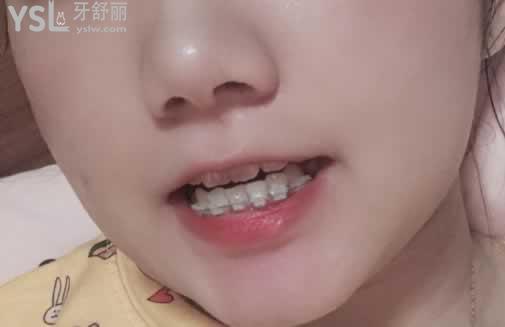 二十歲矯正牙齒后悔，只要去正規(guī)的口腔醫(yī)院就不會(huì)給你后悔的機(jī)會(huì)