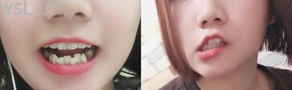 二十歲矯正牙齒后悔，只要去正規(guī)的口腔醫(yī)院就不會(huì)給你后悔的機(jī)會(huì)