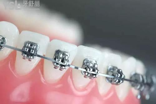 自鎖矯正器：