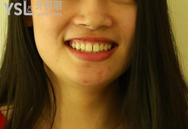 戴牙套一個(gè)月不想戴了，矯正的結(jié)果是值得你堅(jiān)持下去的，加油。
