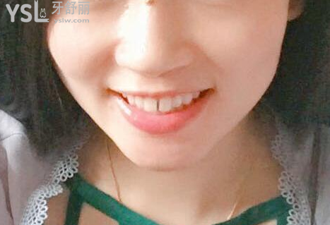戴牙套一個(gè)月不想戴了，矯正的結(jié)果是值得你堅(jiān)持下去的，加油。