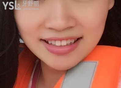 戴牙套一個(gè)月不想戴了，矯正的結(jié)果是值得你堅(jiān)持下去的，加油。