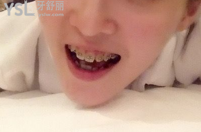 20歲整牙還來得及嗎，有想法的時候立馬行動到時候你會感謝我的