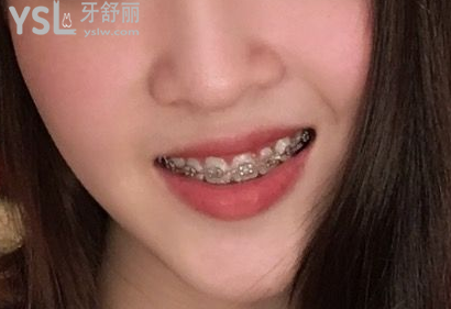 20歲整牙還來得及嗎，有想法的時候立馬行動到時候你會感謝我的