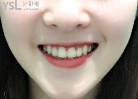20歲整牙還來得及嗎，有想法的時候立馬行動到時候你會感謝我的