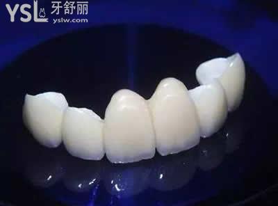 全瓷牙的種類：