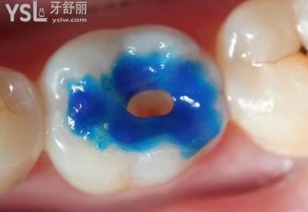 補(bǔ)牙后需要注意那些事情