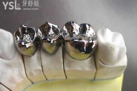 鈷鉻合金烤瓷冠的價格：