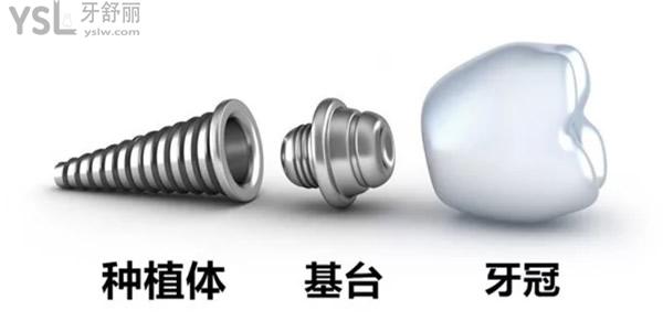 種植牙品牌哪種好