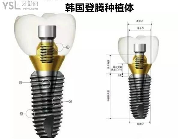 韓國登騰種植體