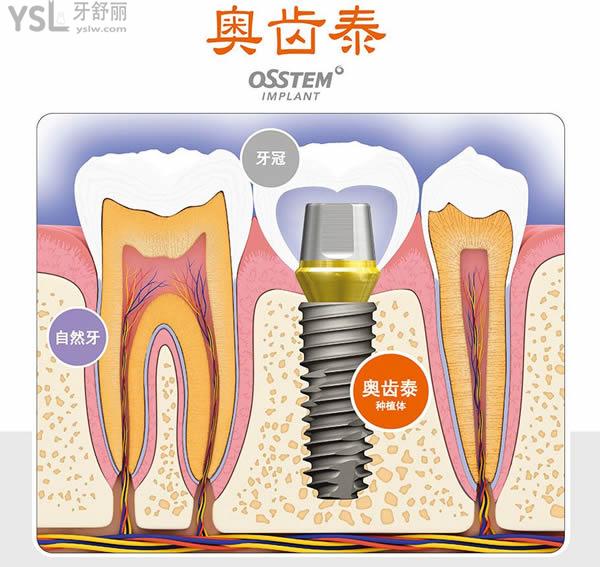 韓國奧齒泰種植體