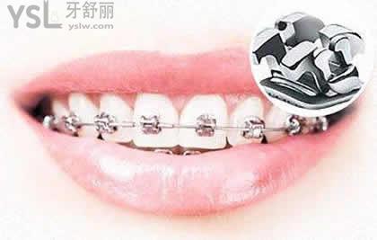 金屬自鎖托槽矯正有以下優(yōu)點(diǎn)：