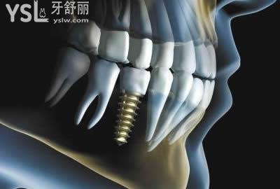 德國(guó)ICX種植系統(tǒng)：