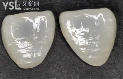 美白牙貼面分為幾種：