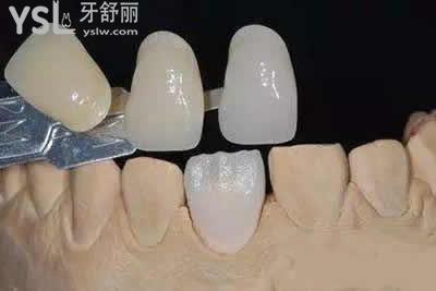 為什么有的人做了牙貼面會(huì)后悔？