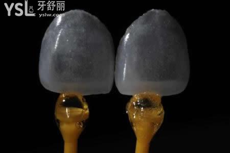 做3D超薄瓷貼面有什么禁忌癥？