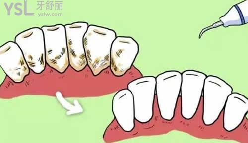 超聲波洗牙
