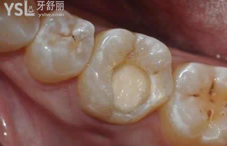 樹脂材料補(bǔ)牙：