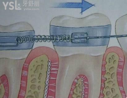 金屬托槽會傷害牙齒嗎？