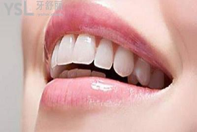全瓷貼面的特點(diǎn)：