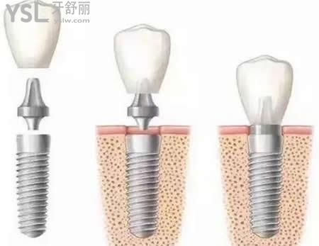 韓國奧齒泰種植體：