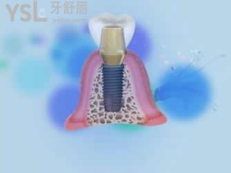 瑞士ITI種植系統(tǒng)