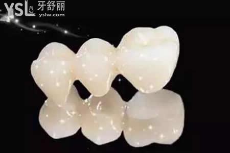 全瓷牙主要分為哪幾種？