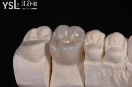 臨床常用的嵌體種類有哪些：