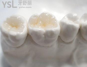 瓷嵌體的適應(yīng)癥和優(yōu)越性：