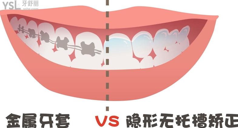 金屬矯正和隱形矯正對(duì)比優(yōu)勢(shì)