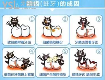 齲齒圖