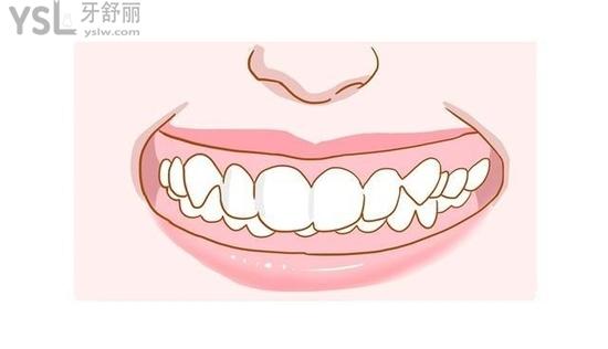 為何深覆合千萬不要矯正？不要被那些賣產(chǎn)品的騙了！