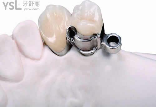 精密附著體可摘局部義齒