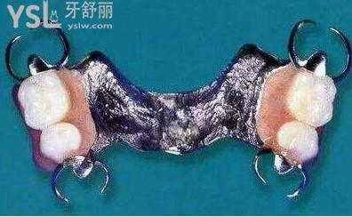 傳統(tǒng)卡環(huán)式可摘局部義齒