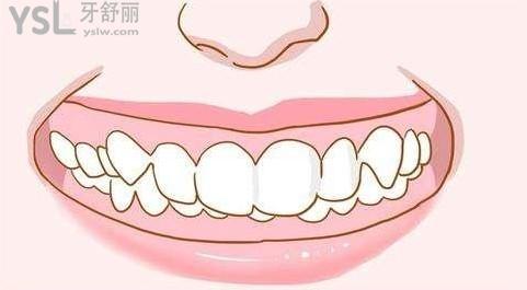 深覆合圖