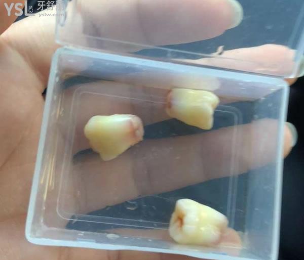 拔智齒后悔死了是真的嗎，拔智齒會很疼嗎？