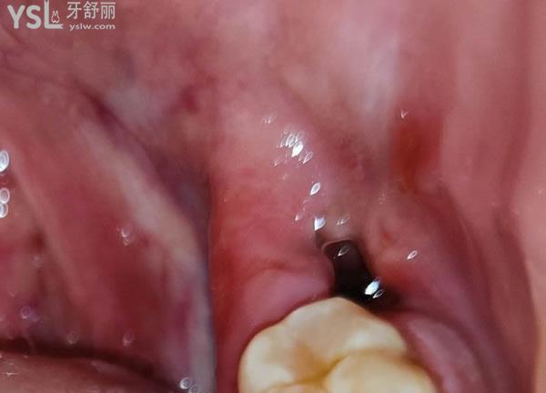 網(wǎng)友分享--干槽癥圖片1