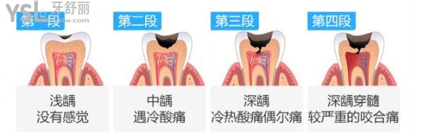 齲齒