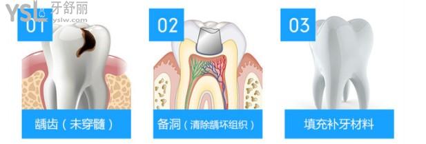 根管治療