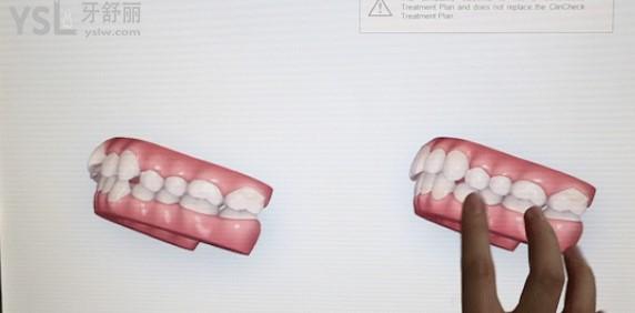 口掃3D模擬