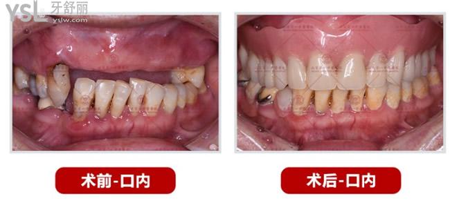 北京京一口腔半口種植牙<span style=