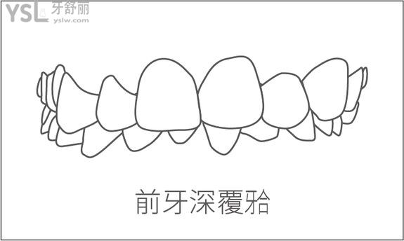 深覆合