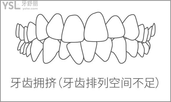 牙齒擁擠
